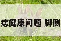 脚侧面长痣健康问题 脚侧面上有痣