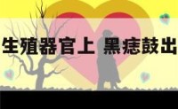 平黑痣长在生殖器官上 黑痣鼓出来和平的有什么区别